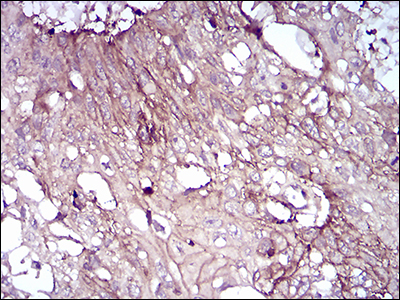 CD6 Antibody - Immunohistochemical analysis of paraffin-embedded esophageal cancer tissues using CD6 mouse mAb with DAB staining.