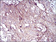 CD6 Antibody - Immunohistochemical analysis of paraffin-embedded esophageal cancer tissues using CD6 mouse mAb with DAB staining.
