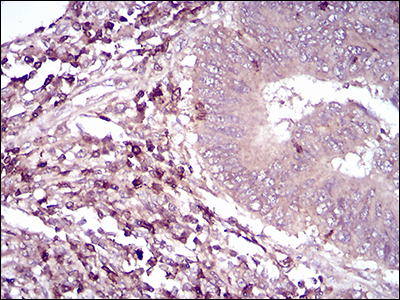 CD6 Antibody - Immunohistochemical analysis of paraffin-embedded rectum cancer tissues using CD6 mouse mAb with DAB staining.