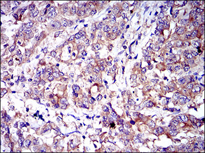 CD6 Antibody - IHC of paraffin-embedded stomach cancer tissues using CD6 mouse monoclonal antibody with DAB staining.
