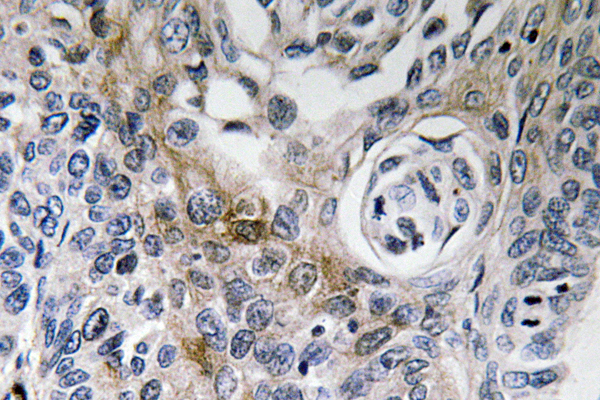 CD63 Antibody - Immunohistochemistry analysis of CD63 antibody in paraffin-embedded human lung carcinoma tissue.