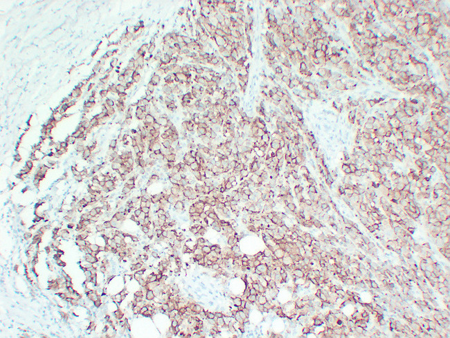 CD63 Antibody - Malignant Melanoma 1