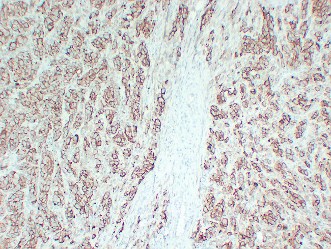 CD63 Antibody - Malignant Melanoma 2