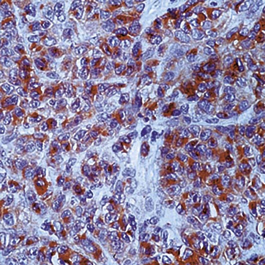 CD63 Antibody - Formalin-fixed, paraffin-embedded human melanoma stained with CD63 antibody.