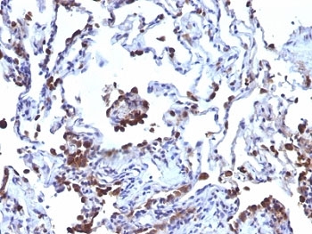 CD63 Antibody - Formalin-fixed, paraffin-embedded human melanoma metastasized to lung stained with CD63 antibody (NKI/C3 + LAMP3/968).  This image was taken for the unmodified form of this product. Other forms have not been tested.