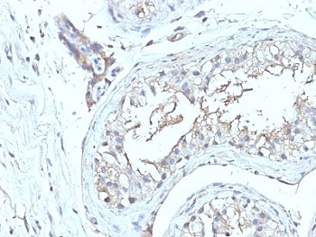 CD63 Antibody - Formalin-fixed, paraffin-embedded human testicular carcinoma stained with CD63 antibody (NKI/C3 + LAMP3/968).  This image was taken for the unmodified form of this product. Other forms have not been tested.