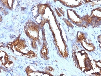 CD63 Antibody - Formalin-fixed, paraffin-embedded human prostate carcinoma stained with CD63 antibody (NKI/C3 + LAMP3/968).  This image was taken for the unmodified form of this product. Other forms have not been tested.