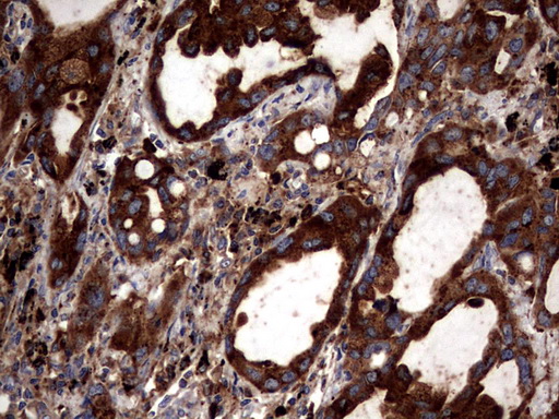 CD63 Antibody - IHC of paraffin-embedded Carcinoma of Human lung tissue using anti-CD63 mouse monoclonal antibody. (Heat-induced epitope retrieval by 1 mM EDTA in 10mM Tris, pH8.5, 120°C for 3min).