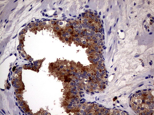 CD63 Antibody - IHC of paraffin-embedded Carcinoma of Human prostate tissue using anti-CD63 mouse monoclonal antibody. (Heat-induced epitope retrieval by 1 mM EDTA in 10mM Tris, pH8.5, 120°C for 3min).
