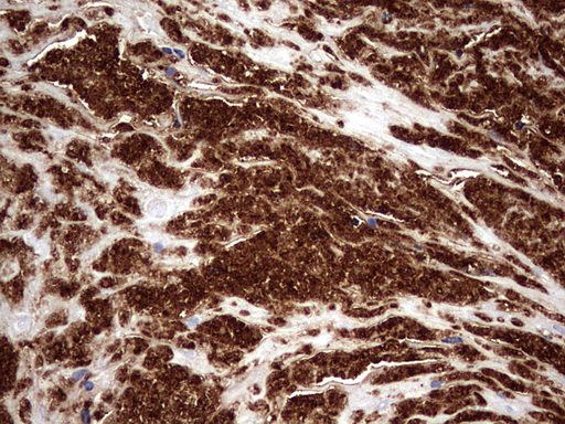 CD63 Antibody - IHC of paraffin-embedded Carcinoma of Human bladder tissue using anti-CD63 mouse monoclonal antibody. (Heat-induced epitope retrieval by 1 mM EDTA in 10mM Tris, pH8.5, 120°C for 3min).