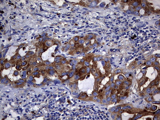 CD63 Antibody - IHC of paraffin-embedded Carcinoma of Human lung tissue using anti-CD63 mouse monoclonal antibody. (Heat-induced epitope retrieval by 1 mM EDTA in 10mM Tris, pH9.0, 120°C for 3min).