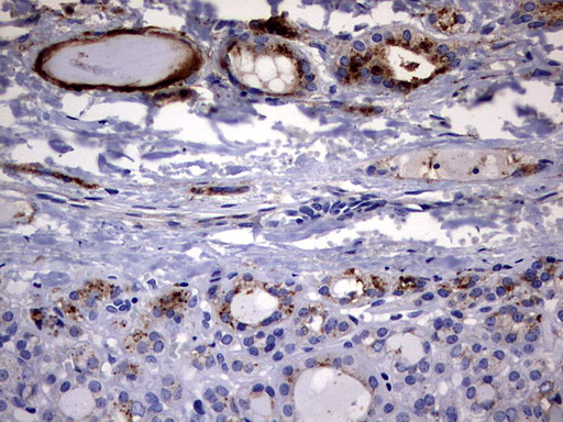 CD63 Antibody - IHC of paraffin-embedded Carcinoma of Human thyroid tissue using anti-CD63 mouse monoclonal antibody. (Heat-induced epitope retrieval by 1 mM EDTA in 10mM Tris, pH9.0, 120°C for 3min).