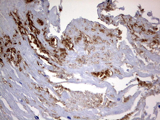 CD63 Antibody - IHC of paraffin-embedded Carcinoma of Human bladder tissue using anti-CD63 mouse monoclonal antibody. (Heat-induced epitope retrieval by 1 mM EDTA in 10mM Tris, pH9.0, 120°C for 3min).