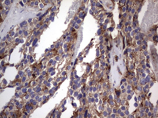 CD63 Antibody - IHC of paraffin-embedded Adenocarcinoma of Human breast tissue using anti-CD63 mouse monoclonal antibody. (Heat-induced epitope retrieval by 1 mM EDTA in 10mM Tris, pH8.5, 120°C for 3min).