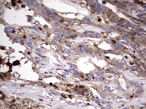 CD63 Antibody - IHC of paraffin-embedded Adenocarcinoma of Human colon tissue using anti-CD63 mouse monoclonal antibody. (Heat-induced epitope retrieval by 1 mM EDTA in 10mM Tris, pH8.5, 120°C for 3min).