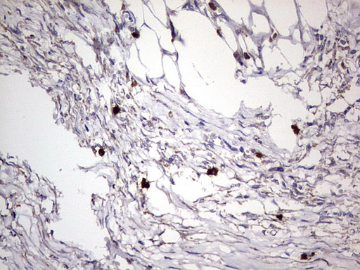 CD63 Antibody - IHC of paraffin-embedded Carcinoma of Human kidney tissue using anti-CD63 mouse monoclonal antibody. (Heat-induced epitope retrieval by 1 mM EDTA in 10mM Tris, pH8.5, 120°C for 3min).