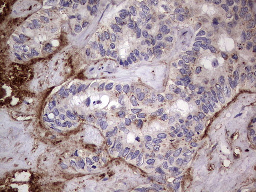 CD63 Antibody - IHC of paraffin-embedded Carcinoma of Human liver tissue using anti-CD63 mouse monoclonal antibody. (Heat-induced epitope retrieval by 1 mM EDTA in 10mM Tris, pH8.5, 120°C for 3min).
