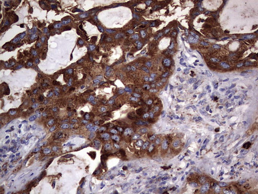 CD63 Antibody - IHC of paraffin-embedded Carcinoma of Human lung tissue using anti-CD63 mouse monoclonal antibody. (Heat-induced epitope retrieval by 1 mM EDTA in 10mM Tris, pH8.5, 120°C for 3min).