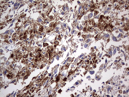 CD63 Antibody - IHC of paraffin-embedded Adenocarcinoma of Human ovary tissue using anti-CD63 mouse monoclonal antibody. (Heat-induced epitope retrieval by 1 mM EDTA in 10mM Tris, pH8.5, 120°C for 3min).