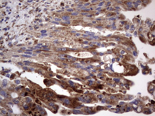 CD63 Antibody - IHC of paraffin-embedded Carcinoma of Human pancreas tissue using anti-CD63 mouse monoclonal antibody. (Heat-induced epitope retrieval by 1 mM EDTA in 10mM Tris, pH8.5, 120°C for 3min).