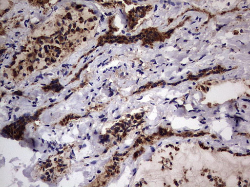 CD63 Antibody - IHC of paraffin-embedded Human thyroid tissue using anti-CD63 mouse monoclonal antibody. (Heat-induced epitope retrieval by 1 mM EDTA in 10mM Tris, pH8.5, 120°C for 3min).