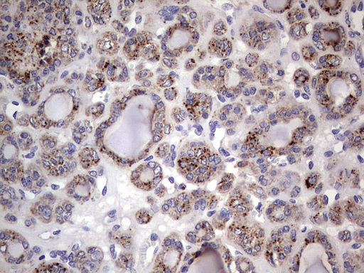 CD63 Antibody - IHC of paraffin-embedded Carcinoma of Human thyroid tissue using anti-CD63 mouse monoclonal antibody. (Heat-induced epitope retrieval by 1 mM EDTA in 10mM Tris, pH8.5, 120°C for 3min).