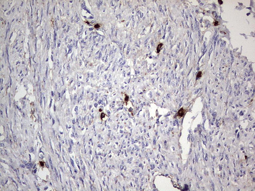 CD63 Antibody - IHC of paraffin-embedded Adenocarcinoma of Human endometrium tissue using anti-CD63 mouse monoclonal antibody. (Heat-induced epitope retrieval by 1 mM EDTA in 10mM Tris, pH8.5, 120°C for 3min).