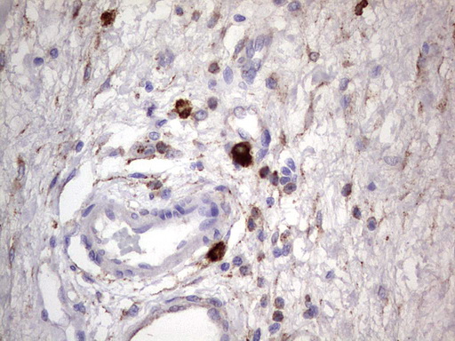 CD63 Antibody - IHC of paraffin-embedded Human bladder tissue using anti-CD63 mouse monoclonal antibody. (Heat-induced epitope retrieval by 1 mM EDTA in 10mM Tris, pH8.5, 120°C for 3min).