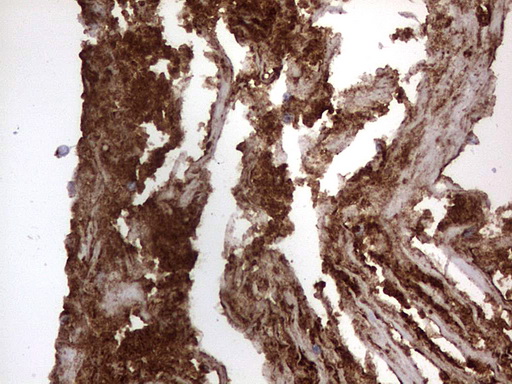 CD63 Antibody - IHC of paraffin-embedded Carcinoma of Human bladder tissue using anti-CD63 mouse monoclonal antibody. (Heat-induced epitope retrieval by 1 mM EDTA in 10mM Tris, pH8.5, 120°C for 3min).