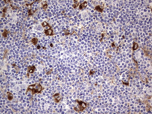 CD63 Antibody - IHC of paraffin-embedded Human lymphoma tissue using anti-CD63 mouse monoclonal antibody. (Heat-induced epitope retrieval by 1 mM EDTA in 10mM Tris, pH8.5, 120°C for 3min).