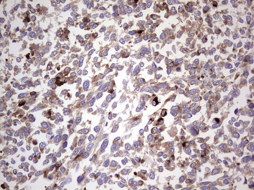 CD63 Antibody - IHC of paraffin-embedded Human melanoma tissue using anti-CD63 mouse monoclonal antibody. (Heat-induced epitope retrieval by 1 mM EDTA in 10mM Tris, pH8.5, 120°C for 3min).