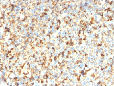 CD63 Antibody - Formalin-paraffin human Melanoma stained with CD63 Recombinant Mouse Monoclonal Antibody (rMX-49.129.5).