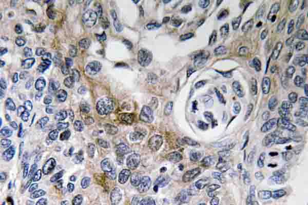 CD63 Antibody - IHC of CD63 (K156) pAb in paraffin-embedded human lung carcinoma tissue.