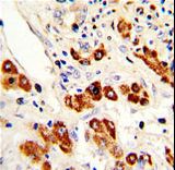 CD66a / CEACAM1 Antibody - Formalin-fixed and paraffin-embedded human hepatocarcinoma with CEACAM Antibody , which was peroxidase-conjugated to the secondary antibody, followed by DAB staining. This data demonstrates the use of this antibody for immunohistochemistry; clinical relevance has not been evaluated.