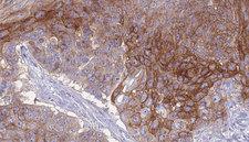 CD66a / CEACAM1 Antibody - 1:100 staining human urothelial carcinoma tissue by IHC-P. The sample was formaldehyde fixed and a heat mediated antigen retrieval step in citrate buffer was performed. The sample was then blocked and incubated with the antibody for 1.5 hours at 22°C. An HRP conjugated goat anti-rabbit antibody was used as the secondary.
