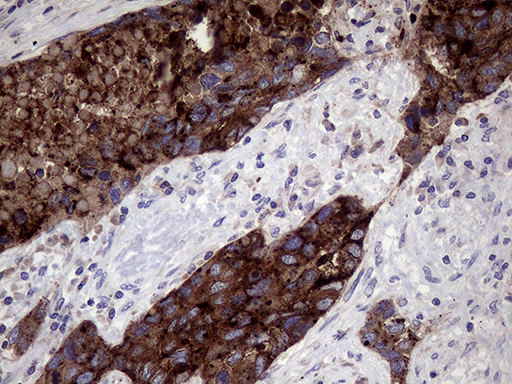 CD66c / CEACAM6 Antibody - Immunohistochemical staining of paraffin-embedded Carcinoma of Human lung tissue using anti-CEACAM6 mouse monoclonal antibody. (Heat-induced epitope retrieval by 1mM EDTA in 10mM Tris buffer. (pH8.5) at 120°C for 3 min. (1:150)