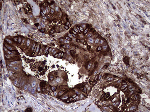CD66c / CEACAM6 Antibody - Immunohistochemical staining of paraffin-embedded Adenocarcinoma of Human colon tissue using anti-CEACAM6 mouse monoclonal antibody. (Heat-induced epitope retrieval by 1mM EDTA in 10mM Tris buffer. (pH8.5) at 120°C for 3 min. (1:150)