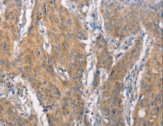 CD66c / CEACAM6 Antibody - Immunohistochemistry of paraffin-embedded Human gastric cancer using CEACAM6 Polyclonal Antibody at dilution of 1:50.