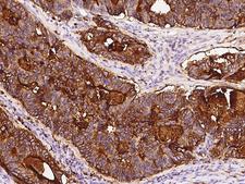 CD66c / CEACAM6 Antibody - Immunochemical staining of human CEACAM6 in human colon carcinoma with rabbit polyclonal antibody at 1:5000 dilution, formalin-fixed paraffin embedded sections.
