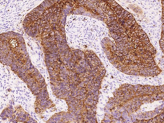 CD66c / CEACAM6 Antibody - Immunochemical staining of human CEACAM6 in human sigmoid colon carcinoma with rabbit polyclonal antibody at 1:5000 dilution, formalin-fixed paraffin embedded sections.