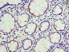 CD66d / CEACAM3 Antibody - Immunohistochemistry of paraffin-embedded human colon cancer using antibody at 1:100 dilution.