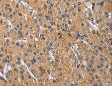 CD66d / CEACAM3 Antibody - Immunohistochemistry of paraffin-embedded Human thyroid cancer using CEACAM3 Polyclonal Antibody at dilution of 1:70.
