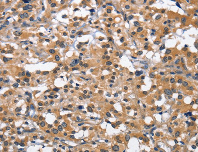 CD66d / CEACAM3 Antibody - Immunohistochemistry of paraffin-embedded Human thyroid cancer using CEACAM3 Polyclonal Antibody at dilution of 1:70.