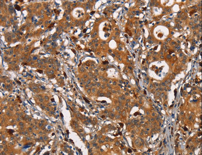CD66d / CEACAM3 Antibody - Immunohistochemistry of paraffin-embedded Human thyroid cancer using CEACAM3 Polyclonal Antibody at dilution of 1:30.
