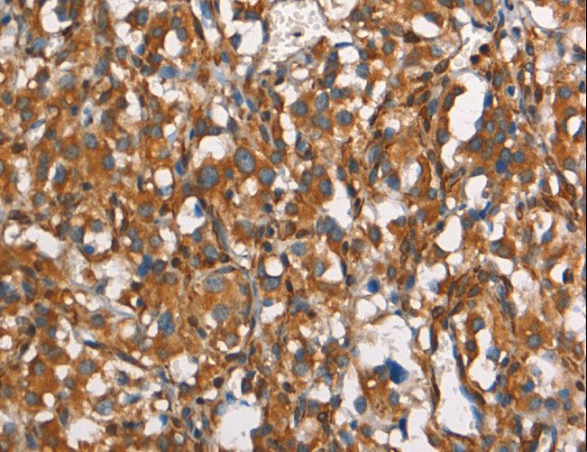 CD66d / CEACAM3 Antibody - Immunohistochemistry of paraffin-embedded Human thyroid cancer using CEACAM3 Polyclonal Antibody at dilution of 1:30.