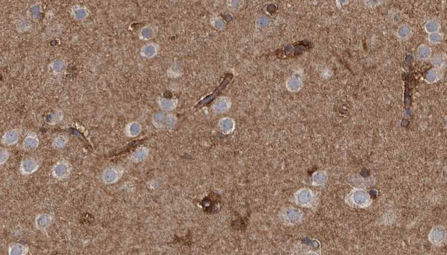 CD66d / CEACAM3 Antibody - 1:100 staining human brain carcinoma tissue by IHC-P. The sample was formaldehyde fixed and a heat mediated antigen retrieval step in citrate buffer was performed. The sample was then blocked and incubated with the antibody for 1.5 hours at 22°C. An HRP conjugated goat anti-rabbit antibody was used as the secondary.