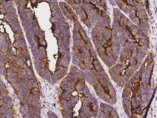CD66d / CEACAM3 Antibody - Immunochemical staining of human CEACAM3 in human colon carcinoma with rabbit polyclonal antibody at 1:1000 dilution, formalin-fixed paraffin embedded sections.
