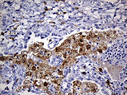 CD68 Antibody - Immunohistochemical staining of paraffin-embedded Carcinoma of Human lung tissue using anti-CD68 mouse monoclonal antibody. (Heat-induced epitope retrieval by 1mM EDTA in 10mM Tris buffer. (pH8.5) at 120°C for 3 min. (1:500)
