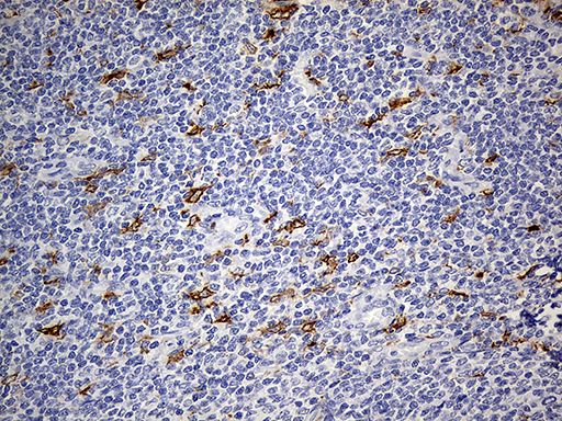 CD68 Antibody - Immunohistochemical staining of paraffin-embedded Human lymphoma tissue using anti-CD68 mouse monoclonal antibody. (Heat-induced epitope retrieval by 1mM EDTA in 10mM Tris buffer. (pH8.5) at 120°C for 3 min. (1:500)