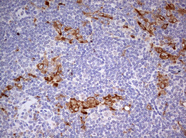 CD68 Antibody - IHC of paraffin-embedded Human lymphoma tissue using anti-CD68 mouse monoclonal antibody. (Heat-induced epitope retrieval by 10mM citric buffer, pH6.0, 120°C for 3min).